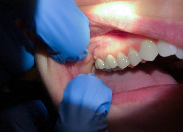 Best Chipped Tooth Repair Near Me  in Greencastle, PA